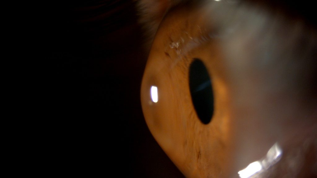Spaltlampenaufnahme eines Auges mit Keratokonus – sichtbare Hornhautvorwölbung bei der Diagnose