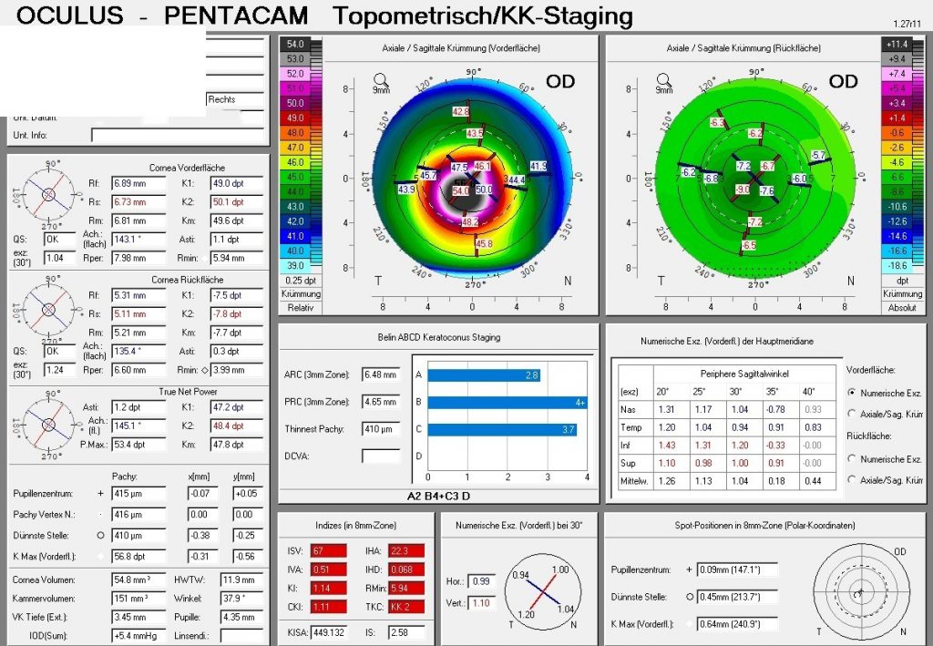 Pentacam Hornhauttopographie bei Keratokonus – Topometrisches KK-Staging zeigt die kegelförmige Vorwölbung der Hornhaut