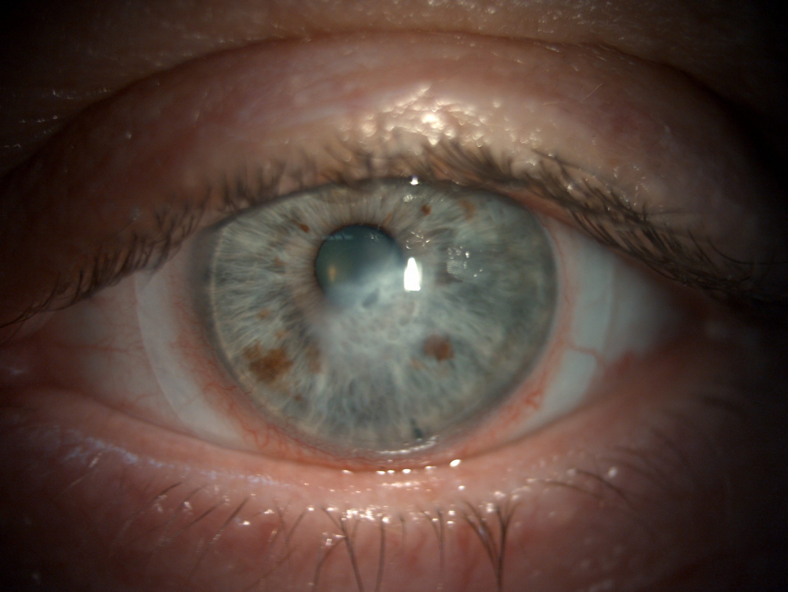 Spaltlampenaufnahme Juni 2025: Sklerallinse auf dem Auge nach Hydrops
