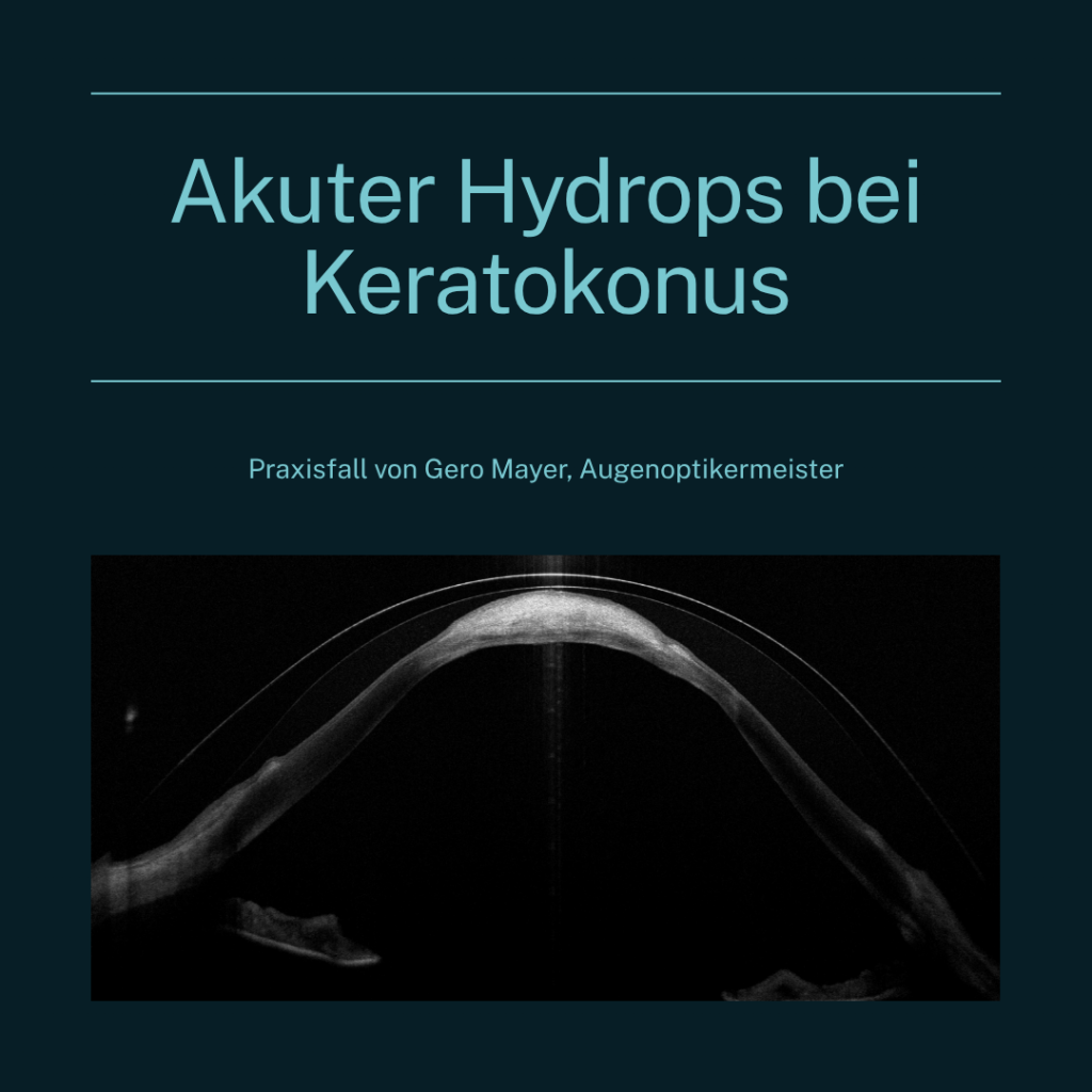 Blog-Beitrag-Akuter-Hydrops-bei-Keratokonus.png