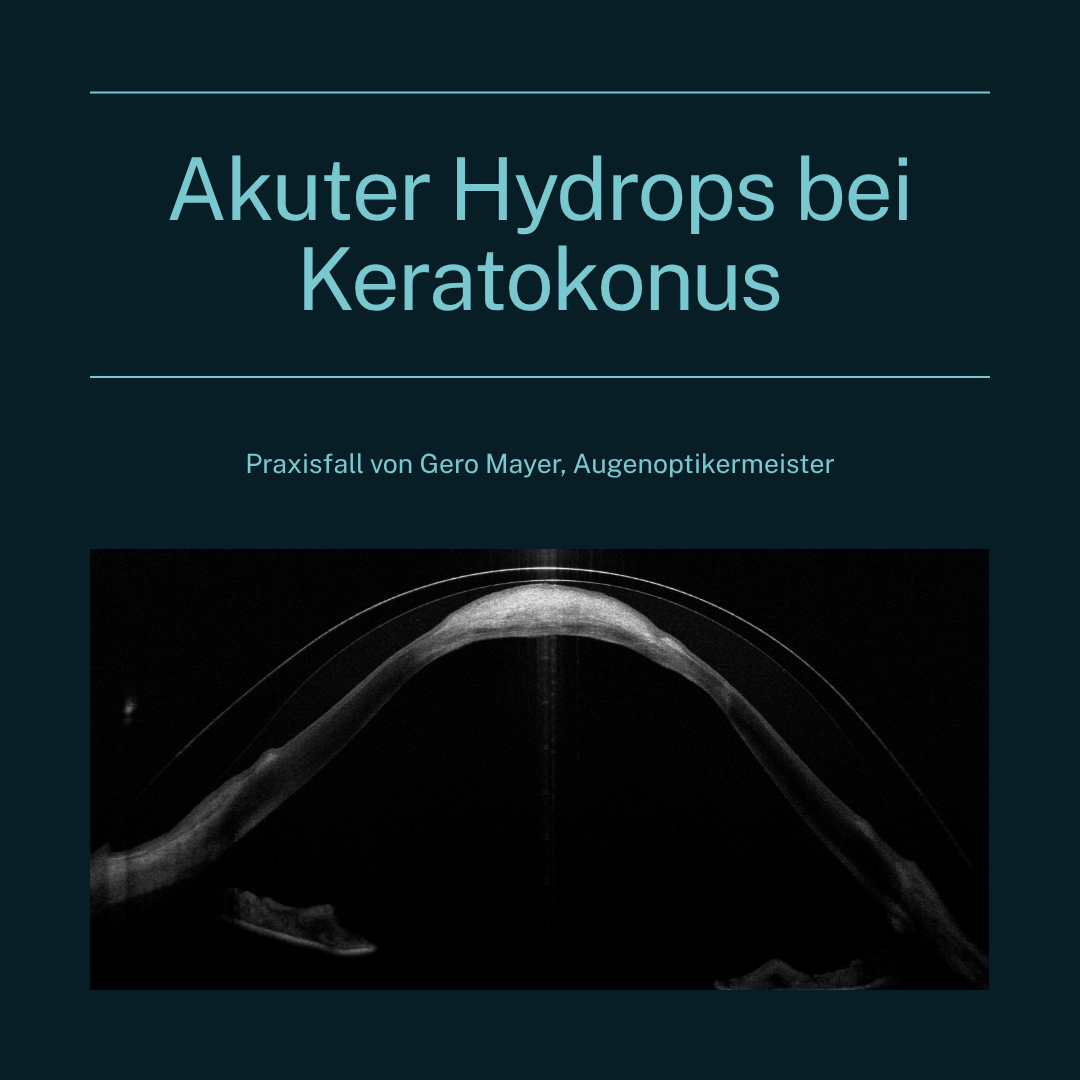 Blog-Beitrag-Akuter-Hydrops-bei-Keratokonus.png