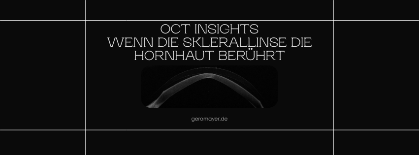 OCT-Aufnahme einer Sklerallinse auf der Hornhaut mit zentralem Kontakt – Zentraler Touch der Sklerallinse