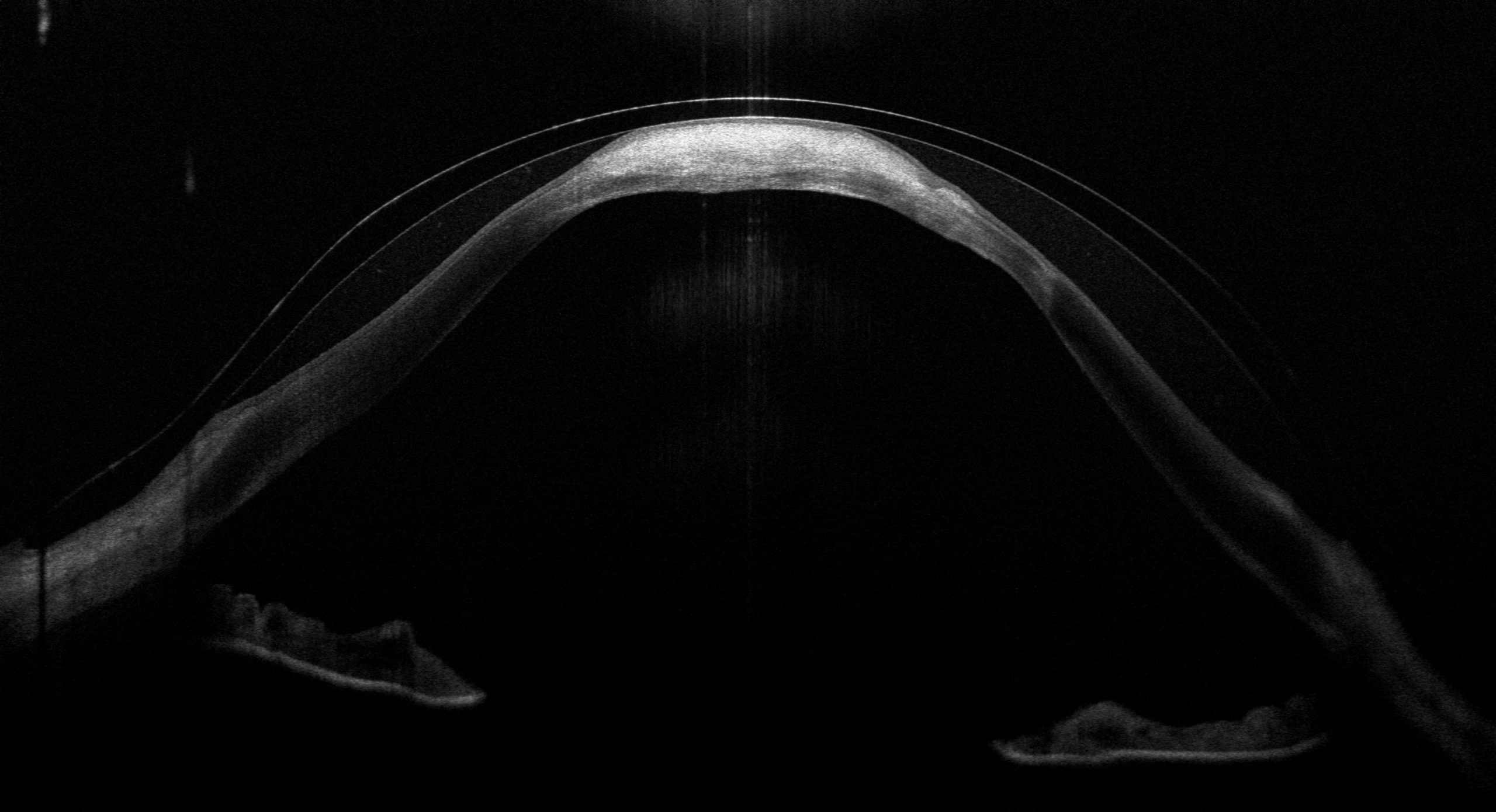 OCT-Querschnitt: Auflage der Sklerallinse auf der Hydrops-Narbe