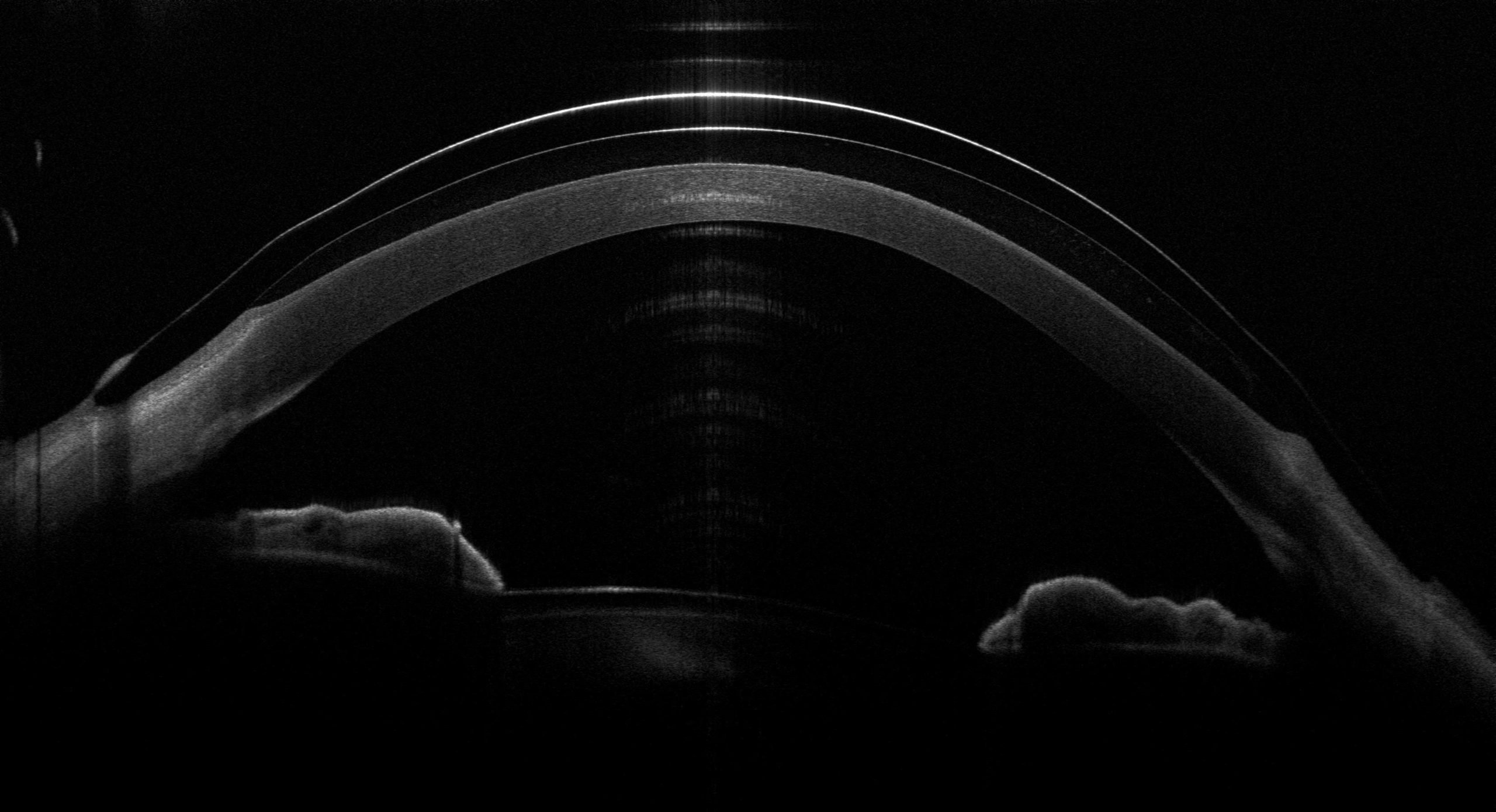 OCT-Querschnitt einer Sklerallinse mit ausreichendem Tränenreservoir über der Hornhaut