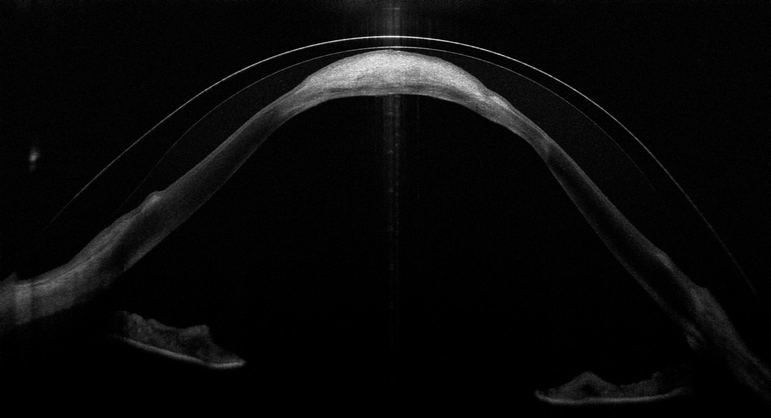 OCT-Querschnitt: Sklerallinse überbrückt die Hornhaut über dem Hydrops-Bereich