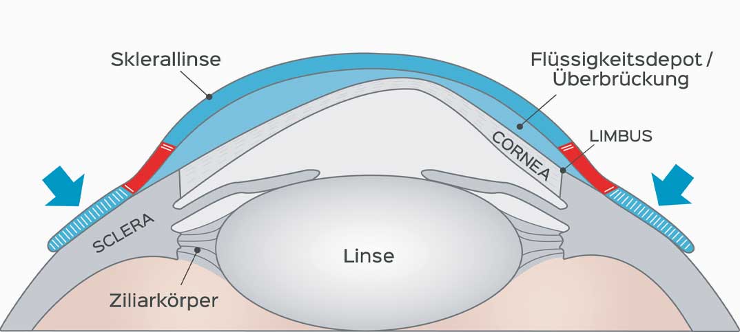 Schema einer SwissLens Sklerallinse – Aufbau, Optikzone, Haptik und Tränenreservoir über der Hornhaut