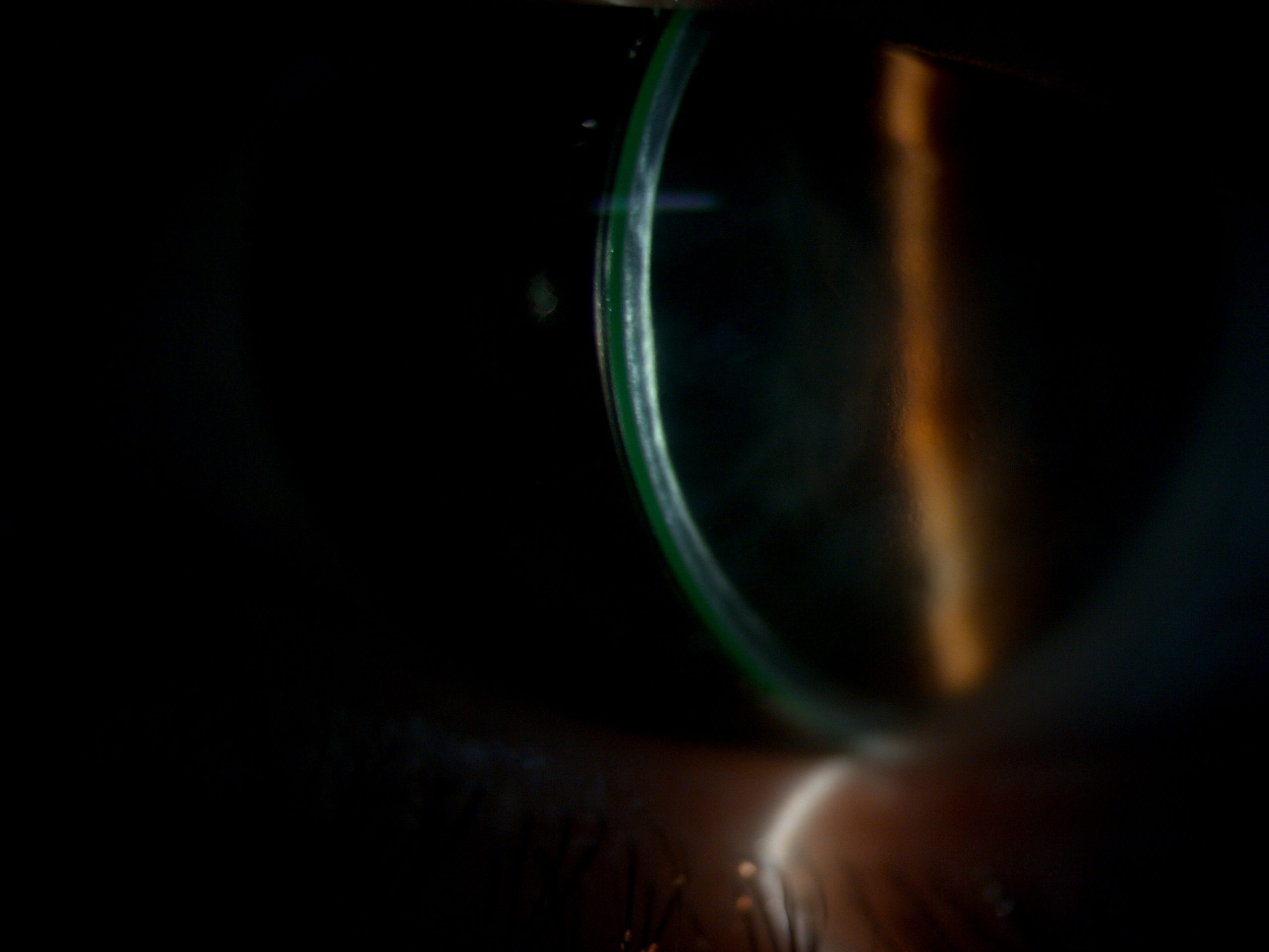 Optischer Schnitt mit Fluoreszein an der Spaltlampe – Sklerallinse über einer Hornhaut mit Hydropsrest, Beurteilung durch Gero Mayer