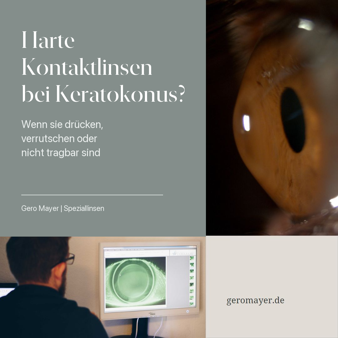 Harte Kontaktlinsen bei Keratokonus - wenn sie drücken, verrutschen oder nicht tragbar sind