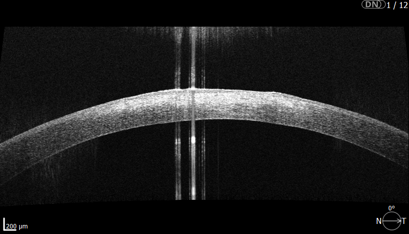 Anonymisierter radialer OCT-Einzelschnitt der Hornhaut