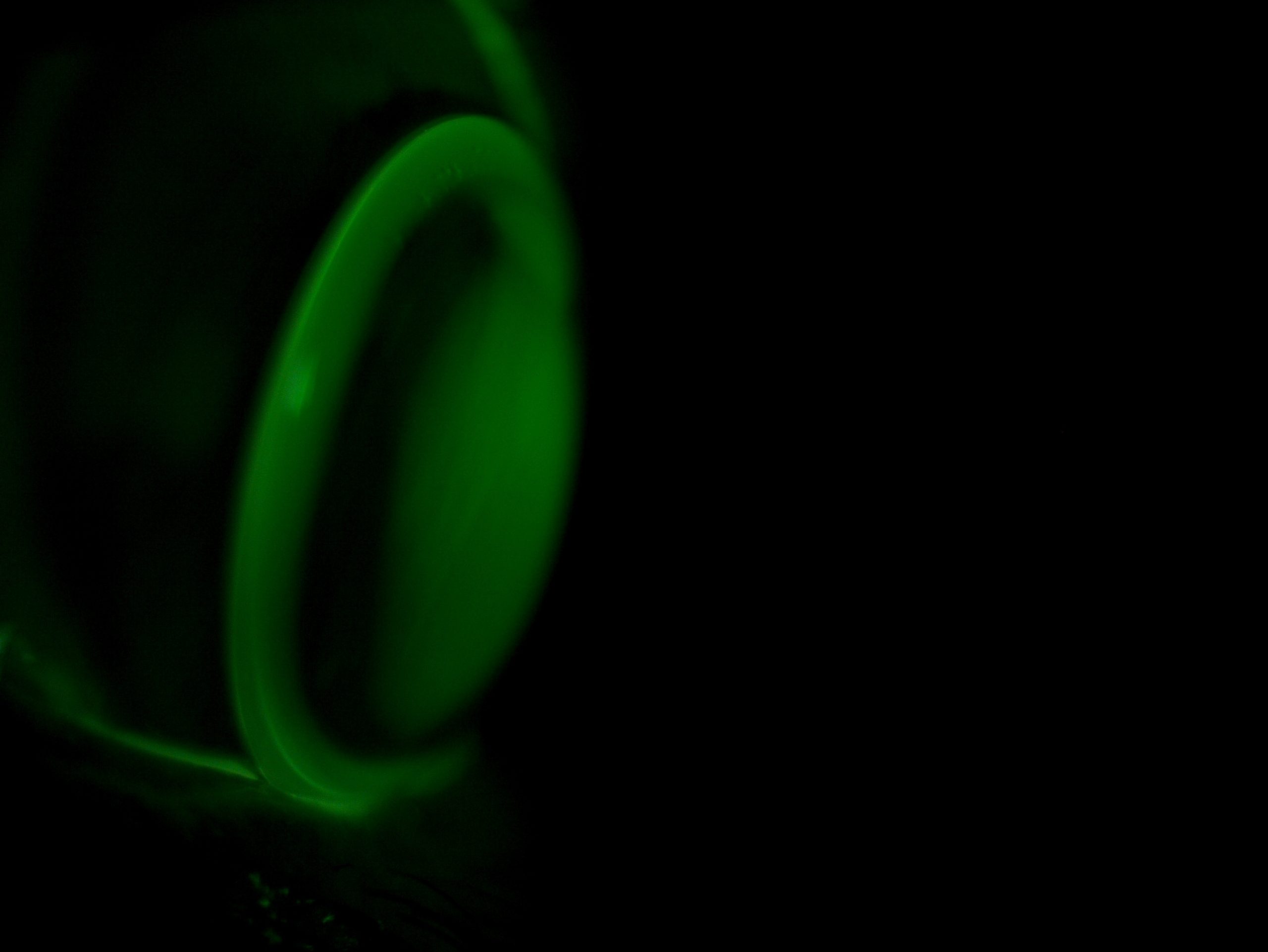 Schräge Ansicht der cornealen Kontaktlinse am rechten Auge unter Fluoreszeinbeleuchtung