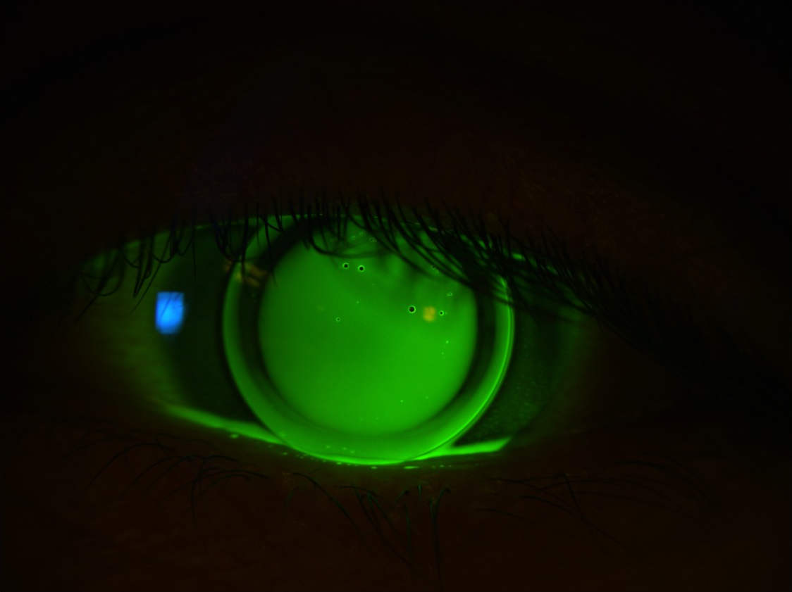 Fluoreszeinaufnahme einer cornealen formstabilen Keratokonuslinse am linken Auge