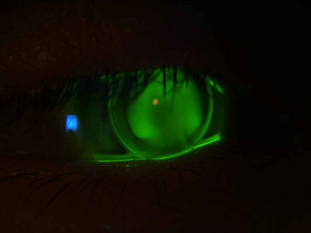 Fluoreszeinaufnahme einer cornealen formstabilen Keratokonuslinse am rechten Auge